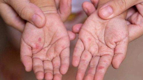 Bu ölkədə epidemiya böyüyür: Ölən uşaqların sayı 712-yə çatdı